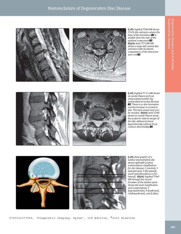 Diagnostic Imaging: Spine 3rd Edition 2015