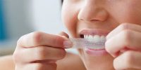 Teeth Whitening Strip Kit