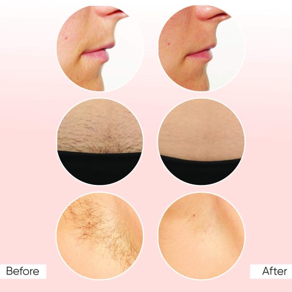 Sensica Sensilight Mini Permanent Hair Removal Device for Men & Women , Advanced RPL Technology System Painless Kit, Hairless Body & Face
