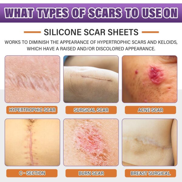 Silicone Scar Sheets,Silicone Scar Tape,Scar Tape For Surgical Scars,Silicone Scar Removal Strips For Surgical,C-Section,Tummy Tuck,Keloid Scars(1.6″X 59″ Roll-1.5M) Keloid Bump Removal