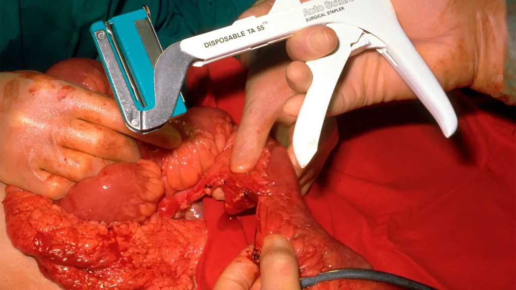 Abdominal Surgery for Crohn’s disease