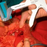 Abdominal Surgery for Crohn’s disease