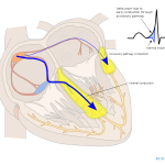 Wolff-Parkinson-White syndrome