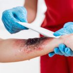 First aid for burns and scalds