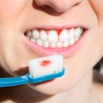 Dental bleeding