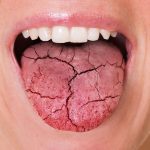Dry mouth syndrome