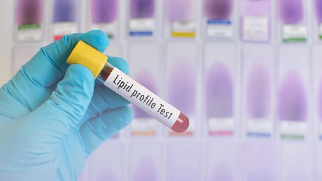 Cholesterol and lipid tests