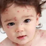 Chickenpox