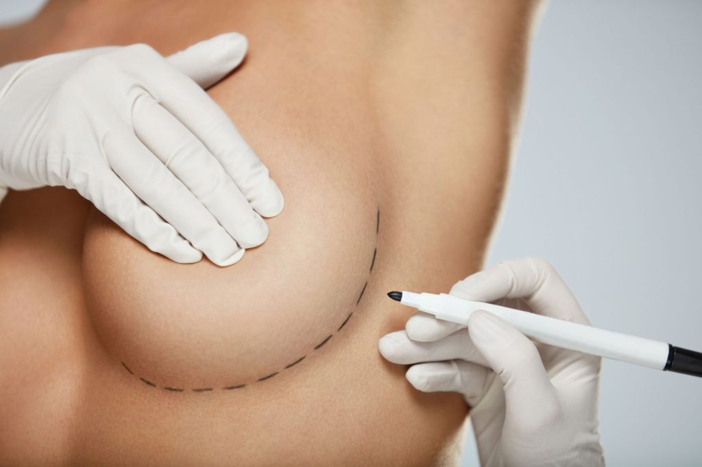 Breast implants (breast augmentation)