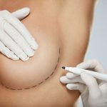 Breast implants (breast augmentation)