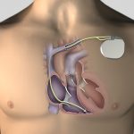 Implantable cardioverter defibrillators