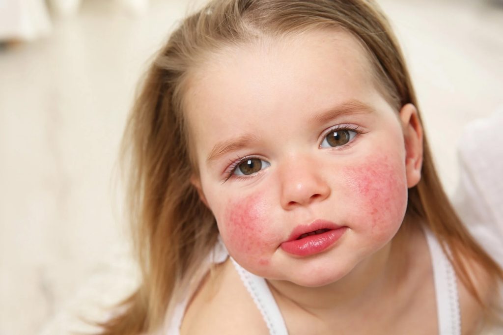 Food allergies (in children)