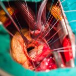 Mitral valve surgery