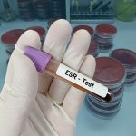 Erythrocyte sedimentation rate (ESR) blood test