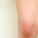 Joint pain and swelling
