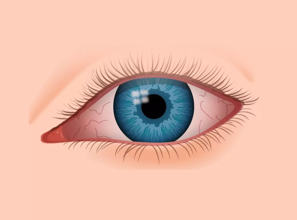 Conjunctivitis – Pink eye