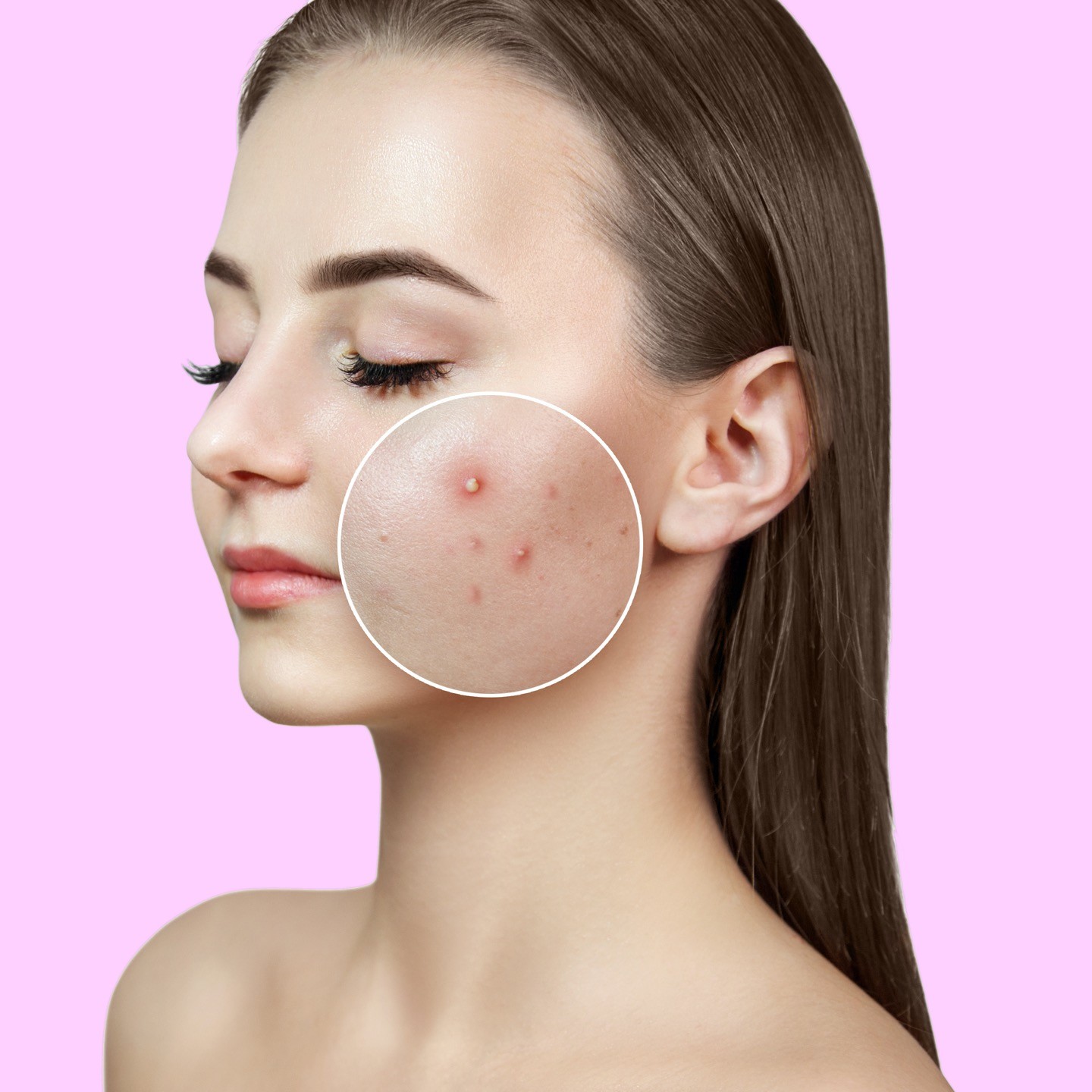 Acne vulgaris