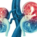 Acute kidney injury