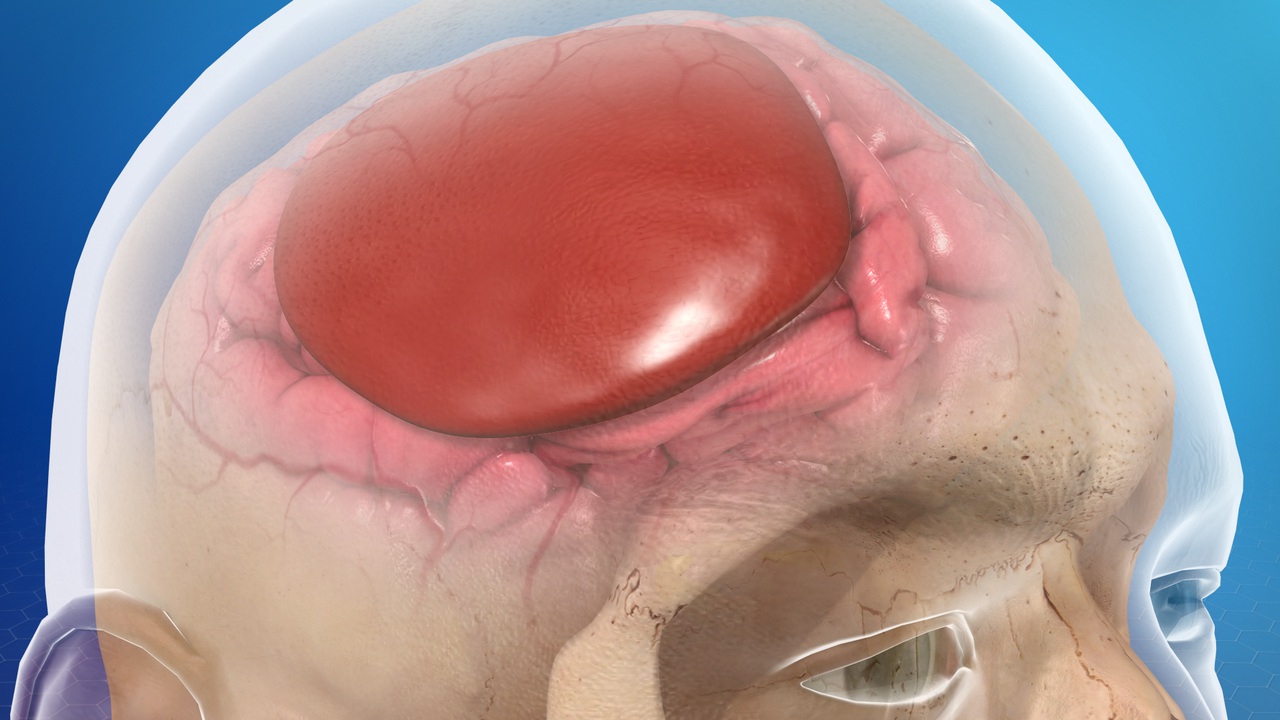 Acute subdural haematoma