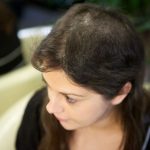 Trichotillomania