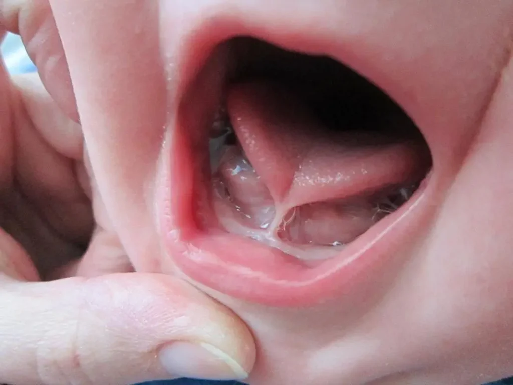 Tongue-tie division (infant)