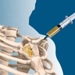 Bone biopsy