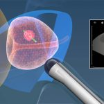 Transrectal ultrasound scan (TRUS) and biopsy for prostate cancer