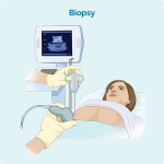 Lymph node ultrasound and biopsy – groin