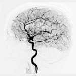 Brain angiogram
