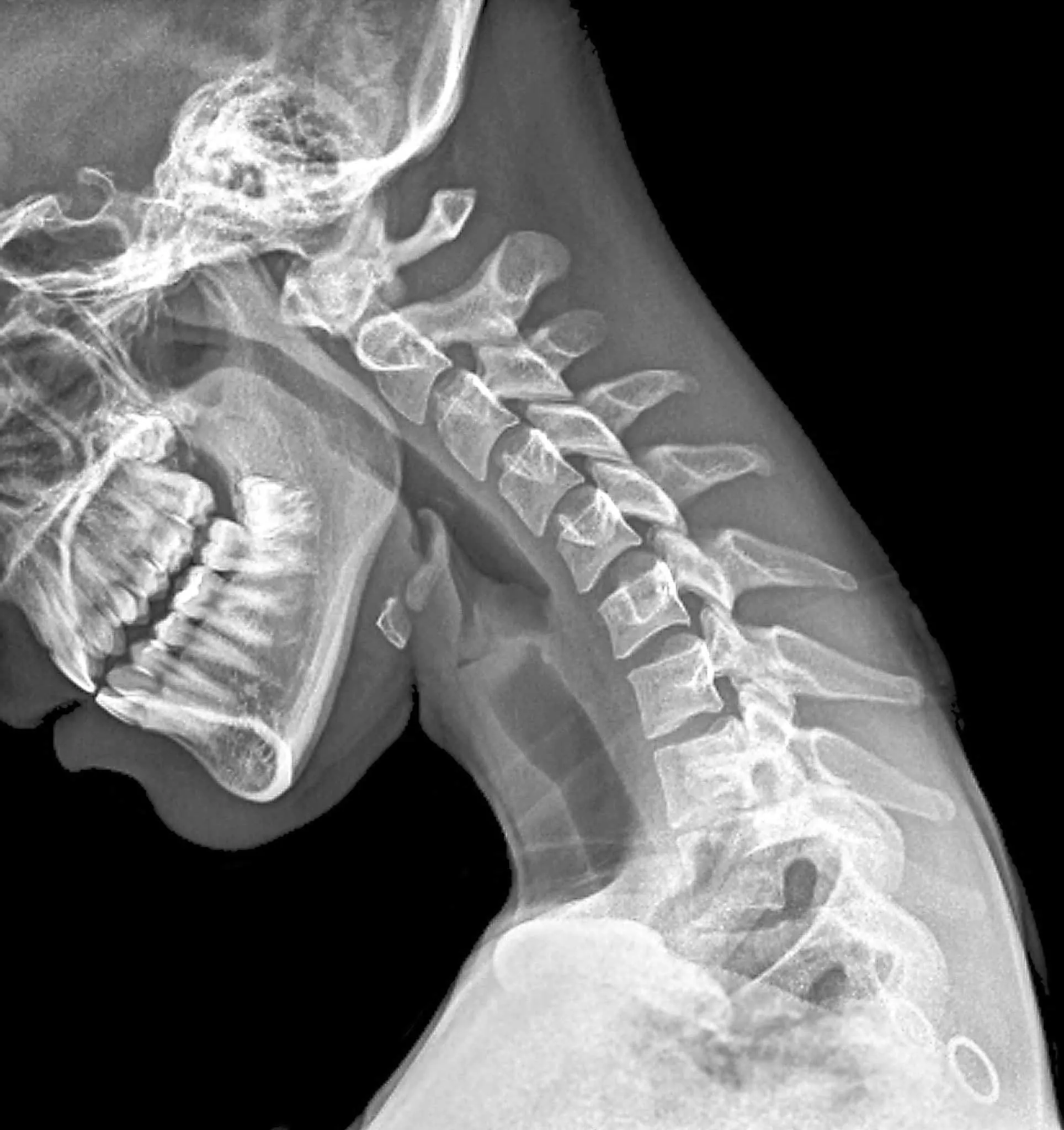X-ray-of-neck.jpg