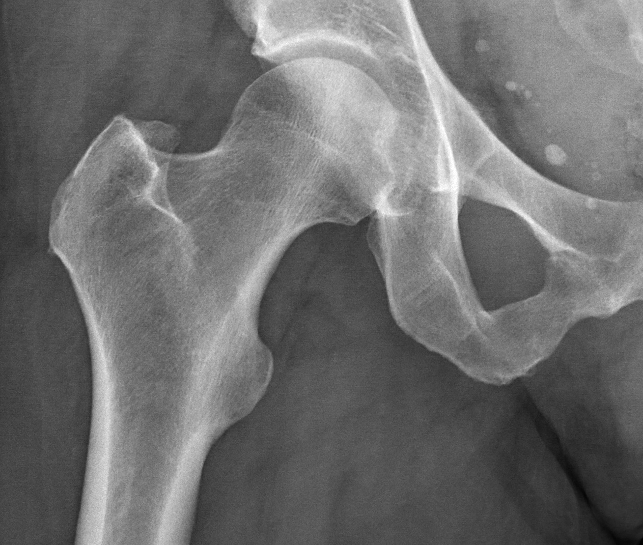 X-ray_of_a_normal_hip
