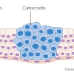 Cancer starts when cells change abnormally