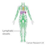 How does cancer affect the lymphatic system?