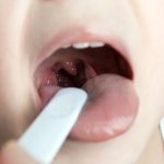 Treating tonsil cancer