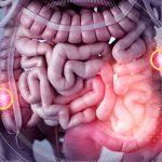 Treatment for small bowel cancer