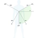 Heart axis deviation