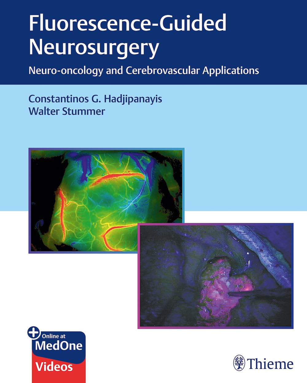 Fluorescence-Guided Neurosurgery. Neuro-oncology and Cerebrovascular Applications (Hadjipanayis) 1st edition (2019)