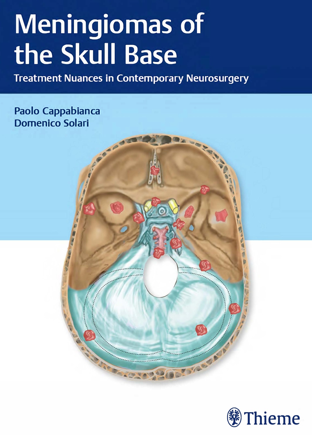 Meningiomas of the skull base. Treatment nuances in contemporary neurosurgery(Cappabianca) 1st edition (2018)