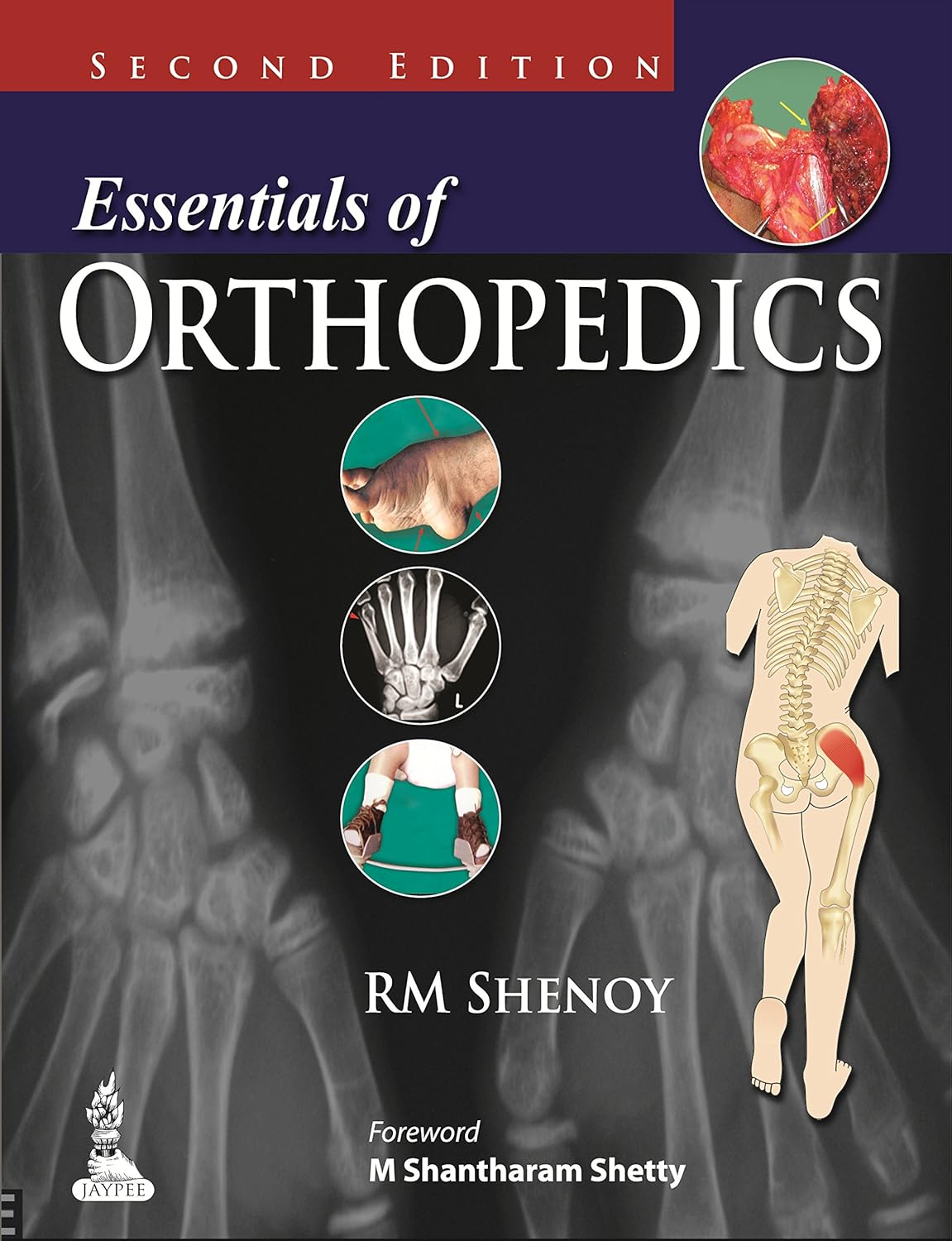 Essentials of Orthopedics (Shenoy) 2nd edition (2014)