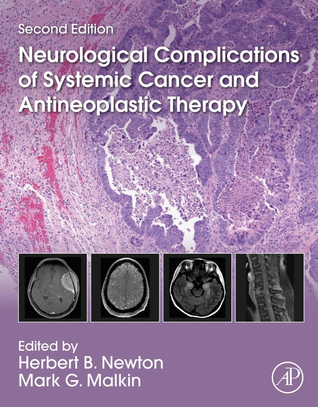 Neurological Complications of Systemic Cancer and Antineoplastic Therapy (Newton) 2 ed (2022)