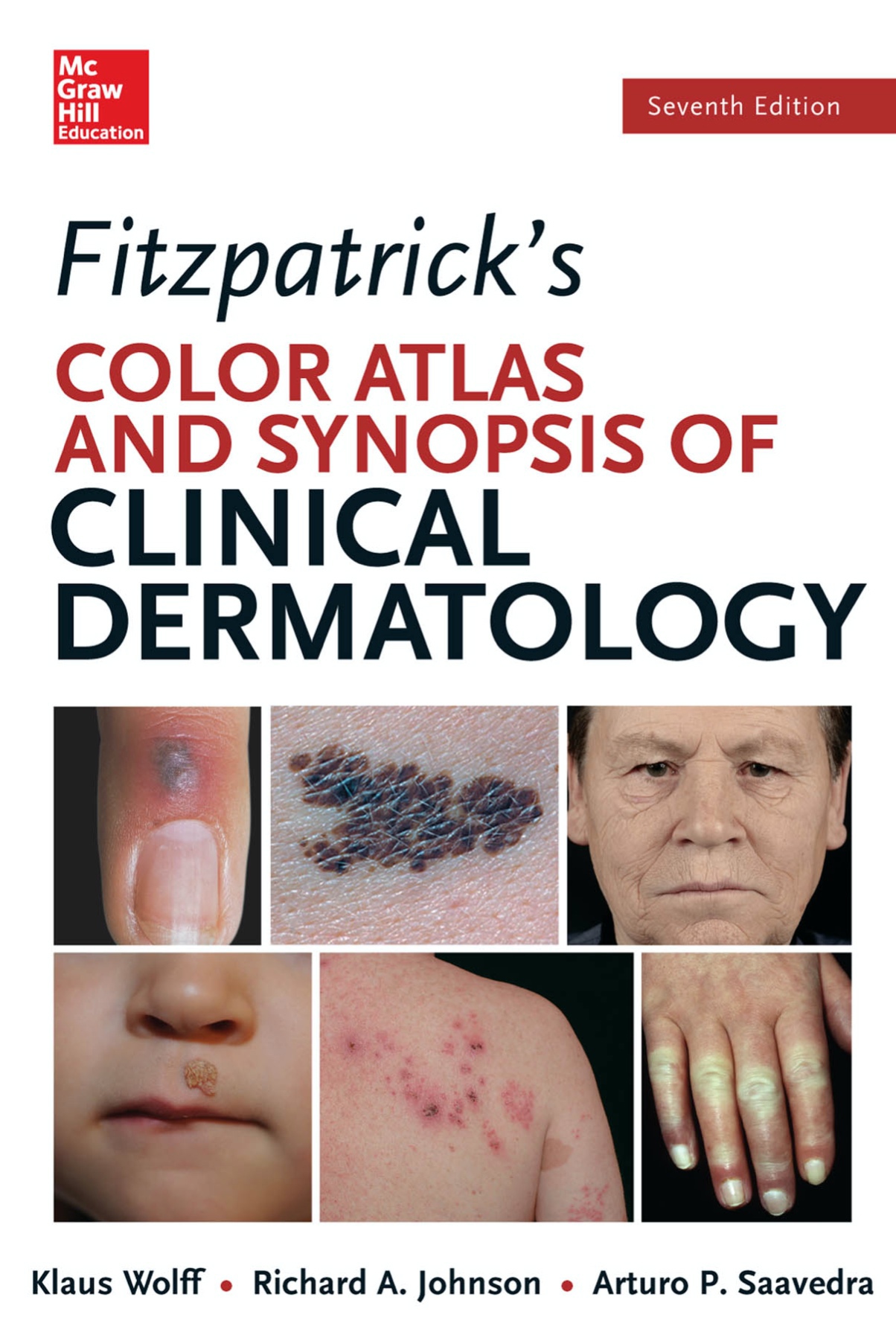 Fitzpatrick’s Color Atlas and Synopsis of Clinical Dermatology (Wolff) 7th edition (2013)